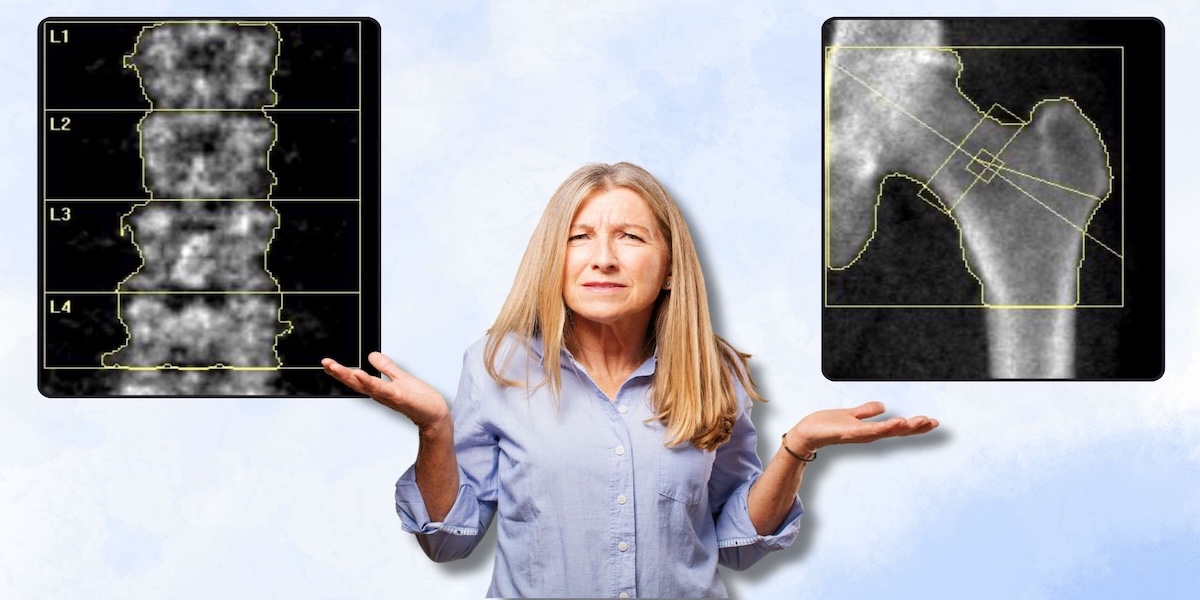 The Two Areas That Reveal Your Bone Strength: Why DEXA Bone Scans Focus on the Spine and Hip