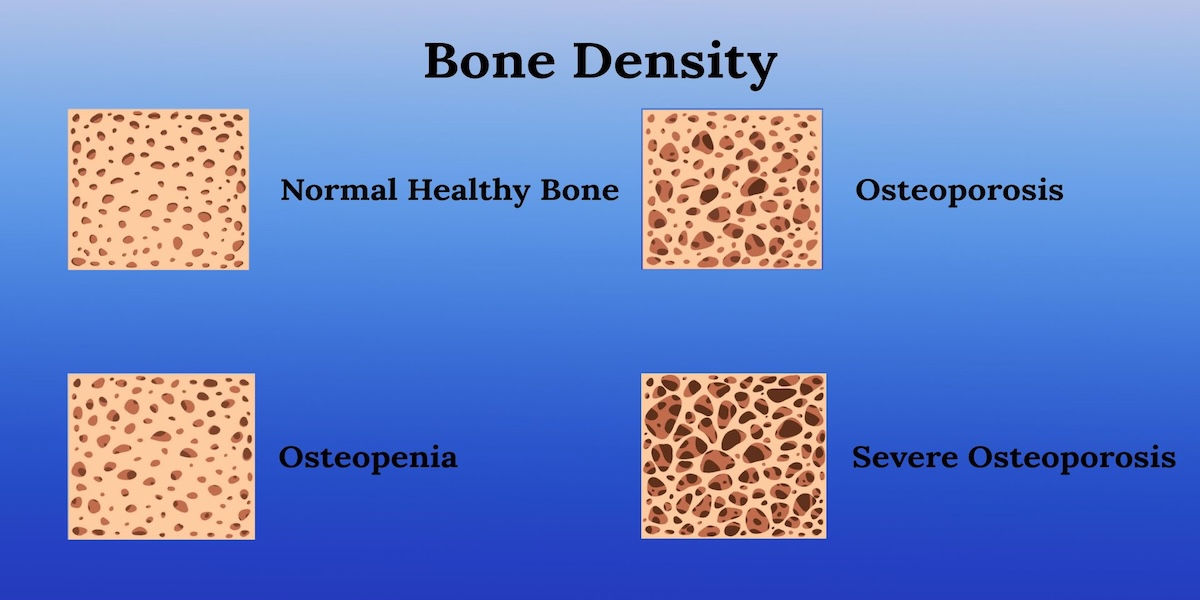 Bone Density Explained - Why Loss Happens Inside Your Bones