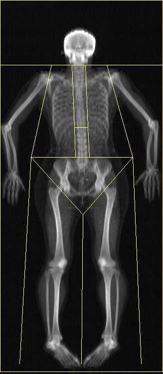 Bone density scan