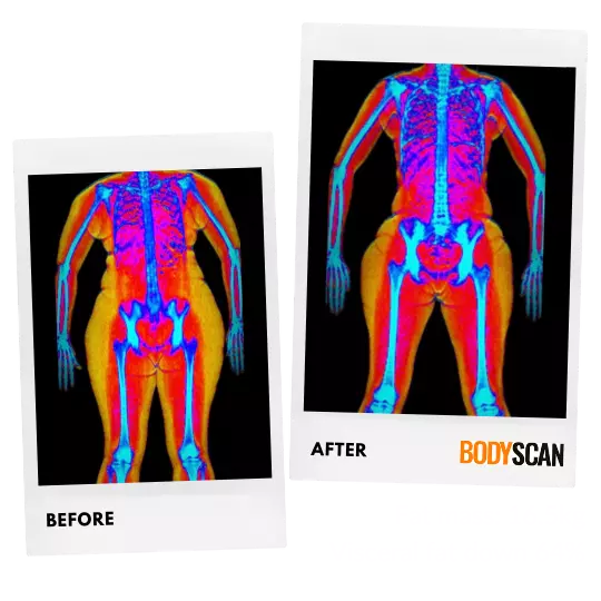 Idelkys, 40's before and after DEXA scan images