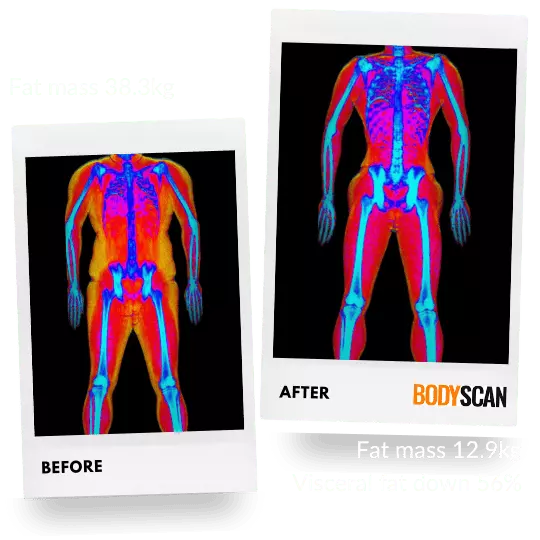 Jinal, 38's before and after DEXA scan images