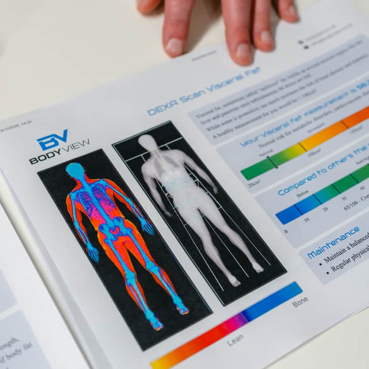 BodyView DEXA body composition report